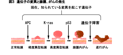 大腸がん